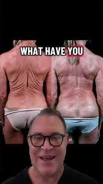 Back Lift Before & After