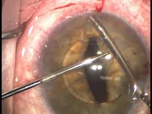AHMED: Repositioning of intraocular lens to iris (suture fixation)
