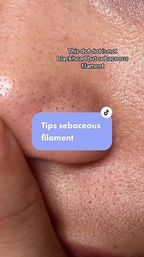 Effective Sebaceous Filament Removal Techniques