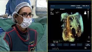 Patent Foramen Ovale with Atrial Septal Defect
