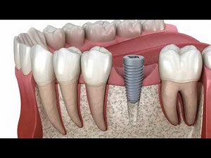 Εμφυτεύματα δοντιών: Η διαδικασία και όλα όσα πρέπει να γνωρίζετε για τα οδοντικά εμφυτεύματα.