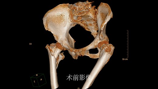 手术教学视频：肥胖患者粗隆间骨折闭合复位PFNA内固定术