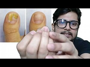 Nail fungus treatment | Nail fungus infection | nakhun me fungal infection