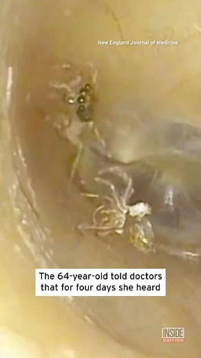 214K views · 984 reactions | A #spider lived in a woman’s ear for four days. Using a suction tube, doctors removed a spider and a molted exoskeleton from a woman’s ear canal. | Inside Edition | Facebook