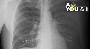 New AI model can accurately estimate age from chest X-rays, research says