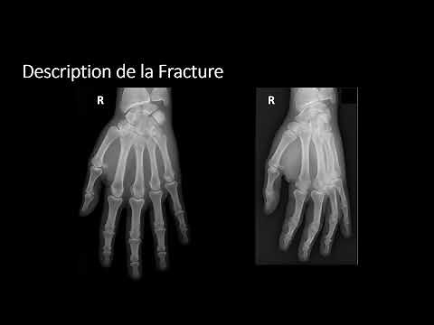 Description des fractures - français2