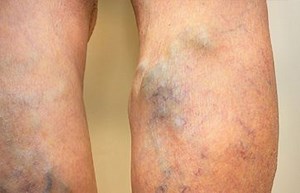 Leg Heaviness Treatment Near You | Vein Treatment Clinic