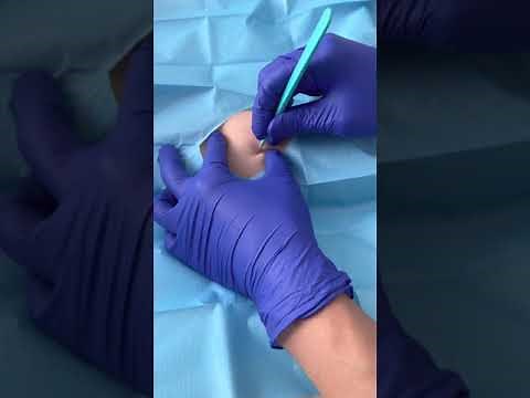 WOMEN’s HEALTH: contraception: IMPLANON REMOVAL