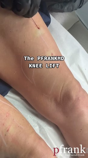 Using suture suspension techniques with barbed PDO threads to lift the sagging skin over the knees. #proaging #threadlift #dermatologist #pfrankmd