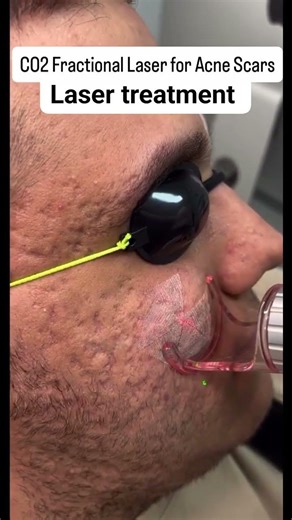 Co2 fractional laser treatment