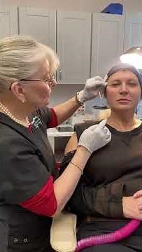 PDO threads for NASOLABIAL folds explained by Dr. Pamela Kulback