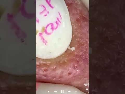 Skincare | Blackheads Removal #748 #tweezers skincare #blackheads blackheads