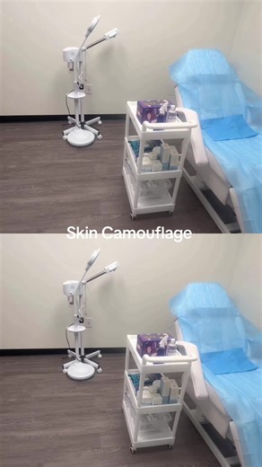 #stretchmarks #stretchmarkremoval #stretchmark #stretchmarkcamouflage