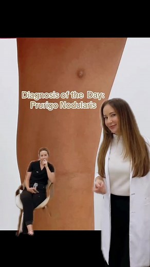 Prurigo Nodularis: Diagnosis and Management Tips