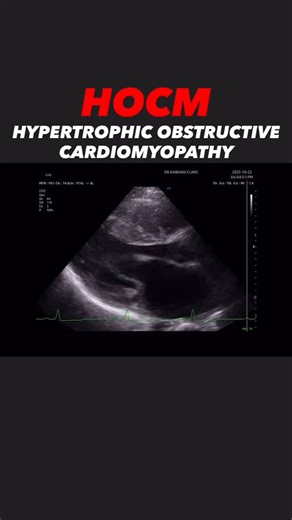 Antonino Di Franco, MD FACC FSIC on Instagram: "🫀HOCM: Hypertrophic Obstructive CardioMyopathy . 👧🏼29-year-old female presented with dyspnea, chest pain, fatigue, and palpitation . 🖥️TTE findings: -LV 4.85 cm, 2.64. cm. -EF:77% FS: 45%, LA: 4.73 cm -Global EF (STE): 61.8%, GL Strain: -21.2% -Asymmetrical Septal Hypertrophy (ASH) -Mitral Valve: Systolic Anterior Motion (SAM) in M Mode MV B Bumb in M Mode (Elevated LVEDP) Severe MR 4/4 -Aortic Valve: Mid Systolic Cl
