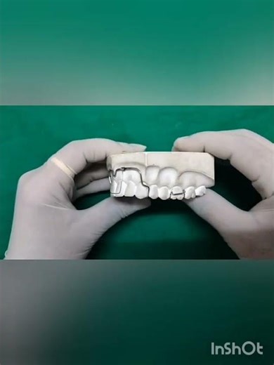 high labial bow with apron spring
