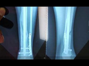 Post Tibia & Fibula Fracture | X-Ray analysis and Bone Growth stage by stage | Part 2 - Recovery