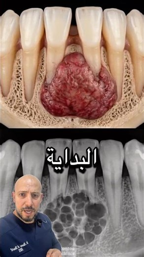 بداية المصيبة تكون صغيرة في الاسنان