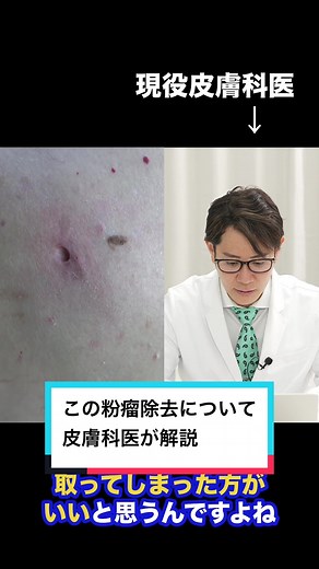 粉瘤手術の解説と除去方法