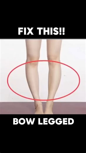 FIX BOW LEGGED NATURALLY 🤩🤩🤩 #bowlegged #genuvalgum #viralpage | Physical Therapy Session