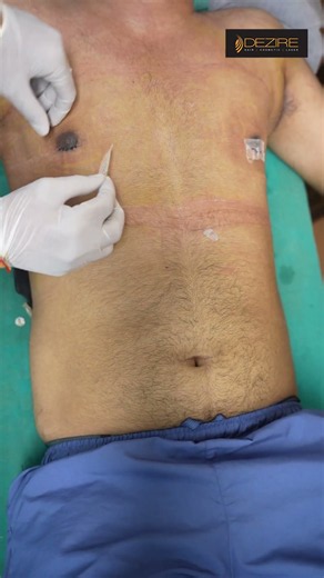 Gynecomastia dressing