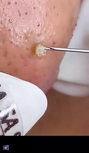 Pimple….#pimplepopping #pimplepop #extractions #bigpimple #pimpleremover #skincleaning #pimplepopper #skinproblem #cleaning