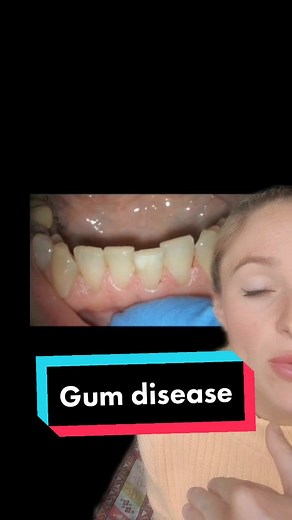 Understanding Gum Disease: Reversible Vs Irreversible