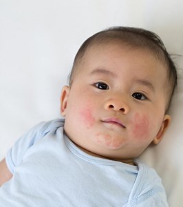 Toddler Acne: Causes, Symptoms, And Treatment