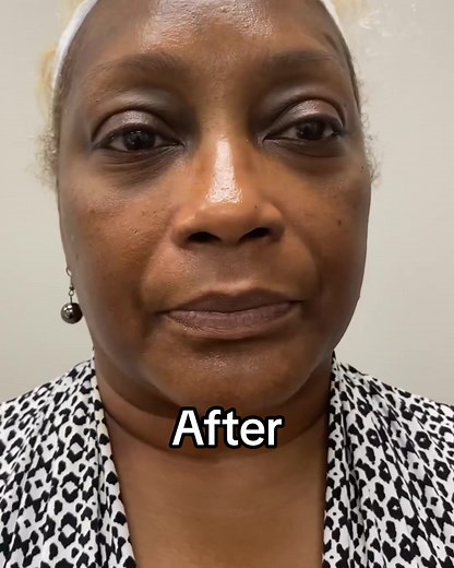 The Perfect Derma™ Peel on TikTok