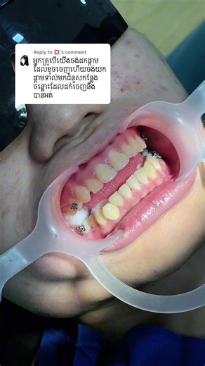 #brightsmiledentalhospital #brace #dental