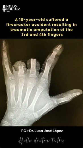 A 10-year-old suffered a firecracker accident resulting in traumatic amputation #health