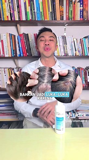 Cara Mengatasi Ketombe dan Merawat Kulit Kepala