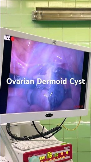 Ovarian Dermoid Cyst / Laparoscopic Resection