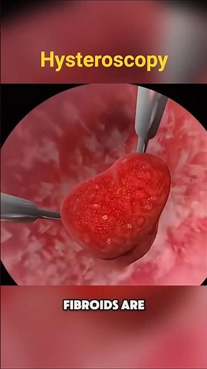 Hysteroscopy Explained: Remove Uterine Polyps & Fibroids Without Surgery!