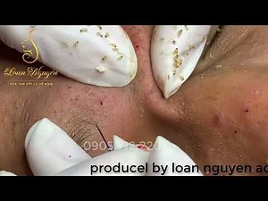 massive blackheads on nose and lips - Clean Giant Blackheads on Nose 2023 - spa - hana spa