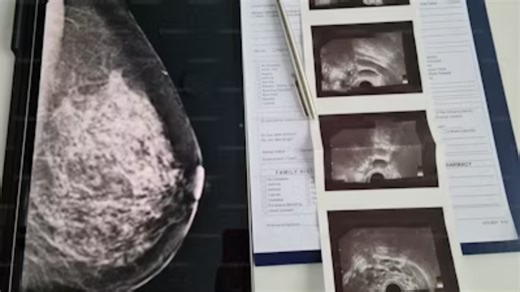 Scientists Develop AI Model That Predicts Breast Cancer Years Before Visible Symptoms