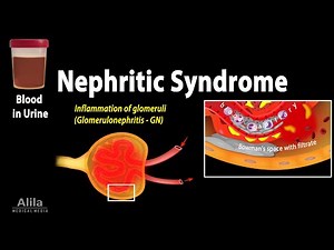 Nephritic Syndrome: Symptoms, Pathophysiology, Causes, Diagnosis and Treatments, Animation.