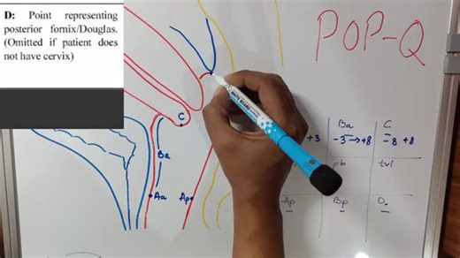 POP-Q评分 (Pelvis Organ Prolapse - Quantification)‪
