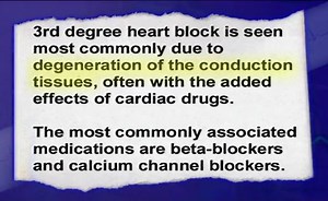 Third degree heart block