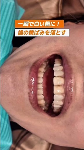 一瞬で白い歯に！半永久ホワイトニングができる治療とは？ #歯 #歯医者 #ミニッシュ #アンビ歯科 #ホワイトニング