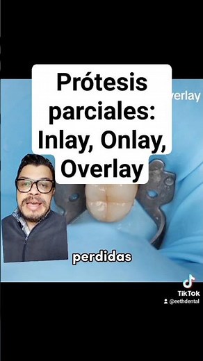 ✔️ Types of Fixed Partial Dentures: Inlay, Onlay, Overlay