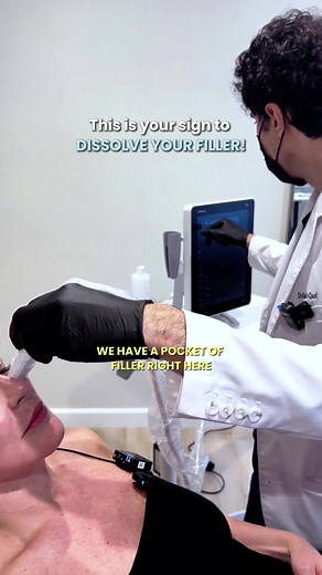 Ultrasound-Guided HA Filler Dissolving Treatment