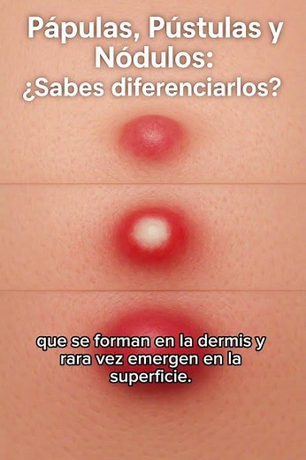 How to distinguish papules, pustules, and nodules on your skin?
