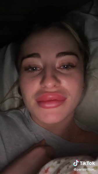 Lip Filler Allergic Reaction: My Swollen Lips Story