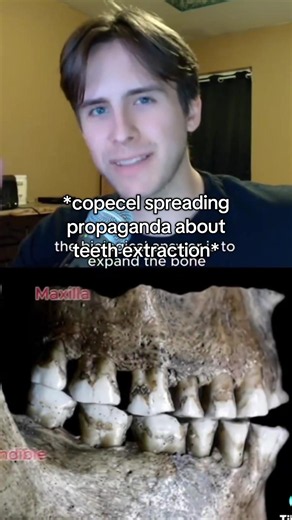 #orthodontics #looks #teeth | premolar extraction