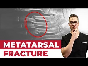 Metatarsalgia & Metatarsal Stress Fractures [Home Treatment!]