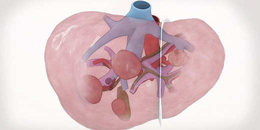Laparoscopic left lateral sectionectomy - TVASurg - The Toronto Video Atlas of Surgery