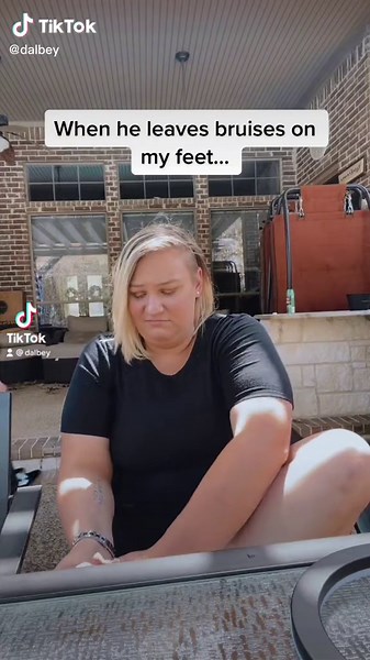 Dealing with Painful Bruises: The Ultimate Guide