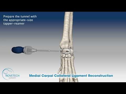 Medial Carpal Collateral Ligament Reconstruction with NOVALIG®