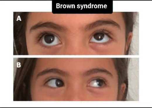 RK NURSE'S HUB | Brown syndrome is a rare eye motility disorder characterized by the inability to move the affected eye upward, especially when looking... | Instagram